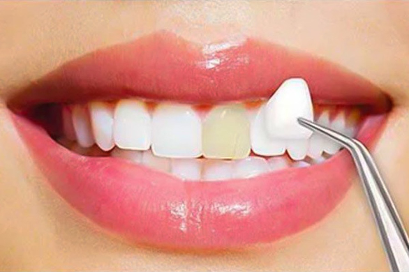 Facette dentaire - Pose de facettes chez votre dentiste à Javea
