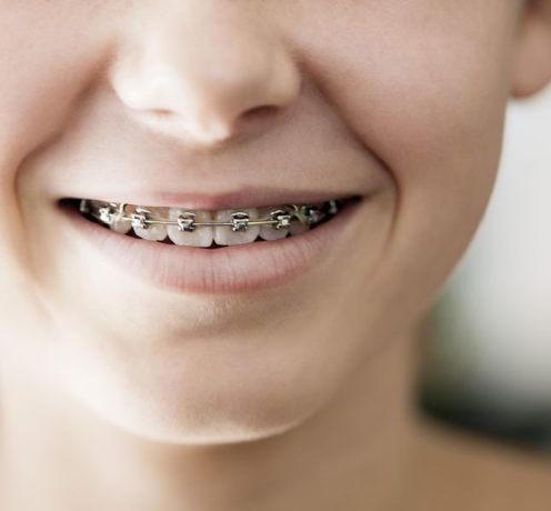 Orthodontie enfants Smile and Care