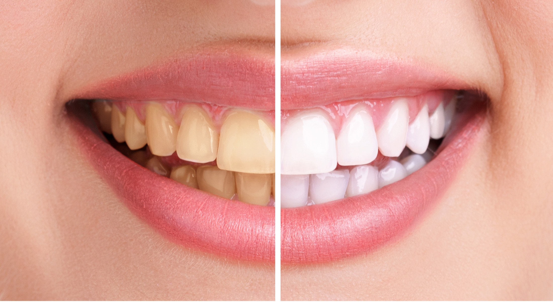 Soins esthétiques dentaires : spécialités Smile and Care